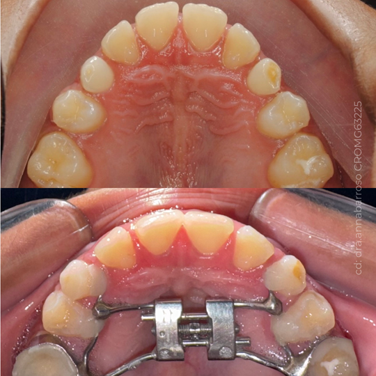 Antes e Depois 33